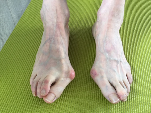 Hallux valgus verstehen Miniworkshop
