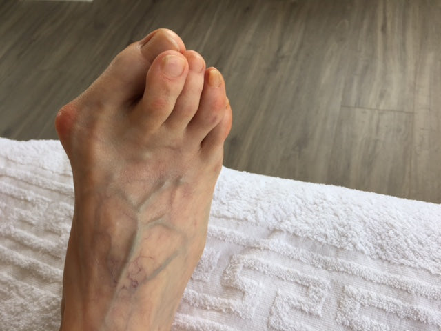 Hallux valgus verstehen (Mini-Workshop)