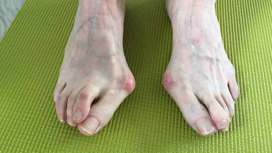 Hallux Valgus - die Schiefstellung der Großzehe