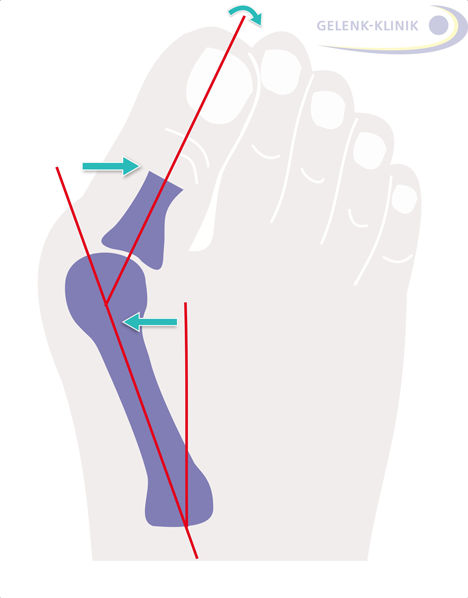 Hallux valgus verstehen (Online Worksshop)